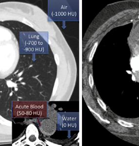 A Practical Guide to Read Chest CT For Emergency and Critical Care Physicians