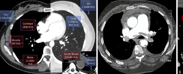 A Practical Guide to Read Chest CT For Emergency and Critical Care Physicians
