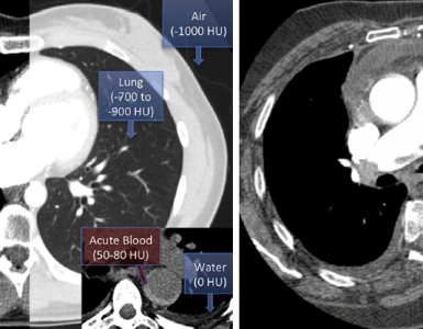 A Practical Guide to Read Chest CT For Emergency and Critical Care Physicians